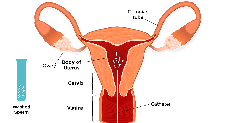 Intrauterine Insemination IUI procedure